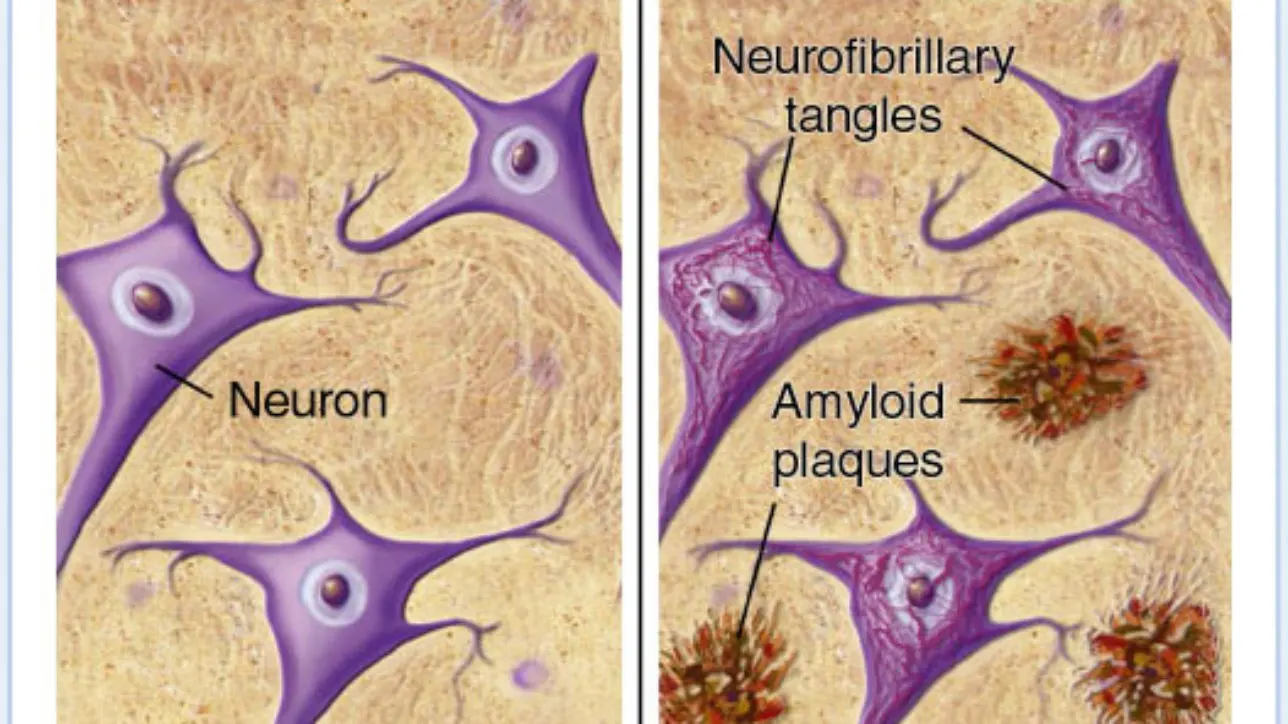 Alzheimer’s and Cannabis